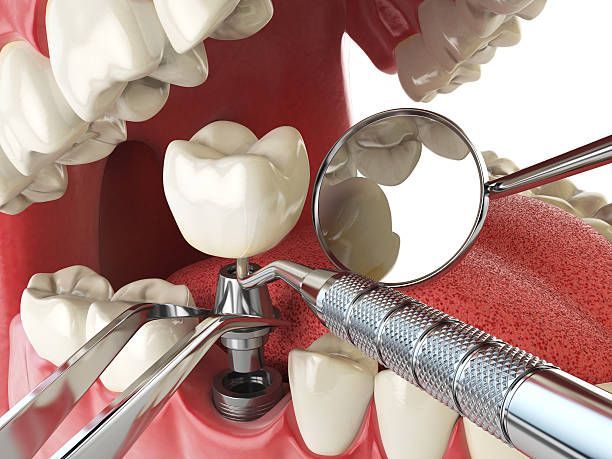 Best Emergency Treatment for Dental Infections or Abscesses in Waxahachie, TX